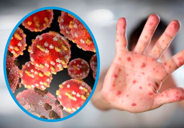 Salud explica qué es la viruela del mono y cómo se transmite. Foto: gentileza.
